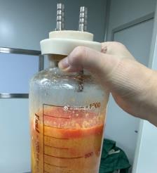 内蒙古水动力吸脂手术要做多久？